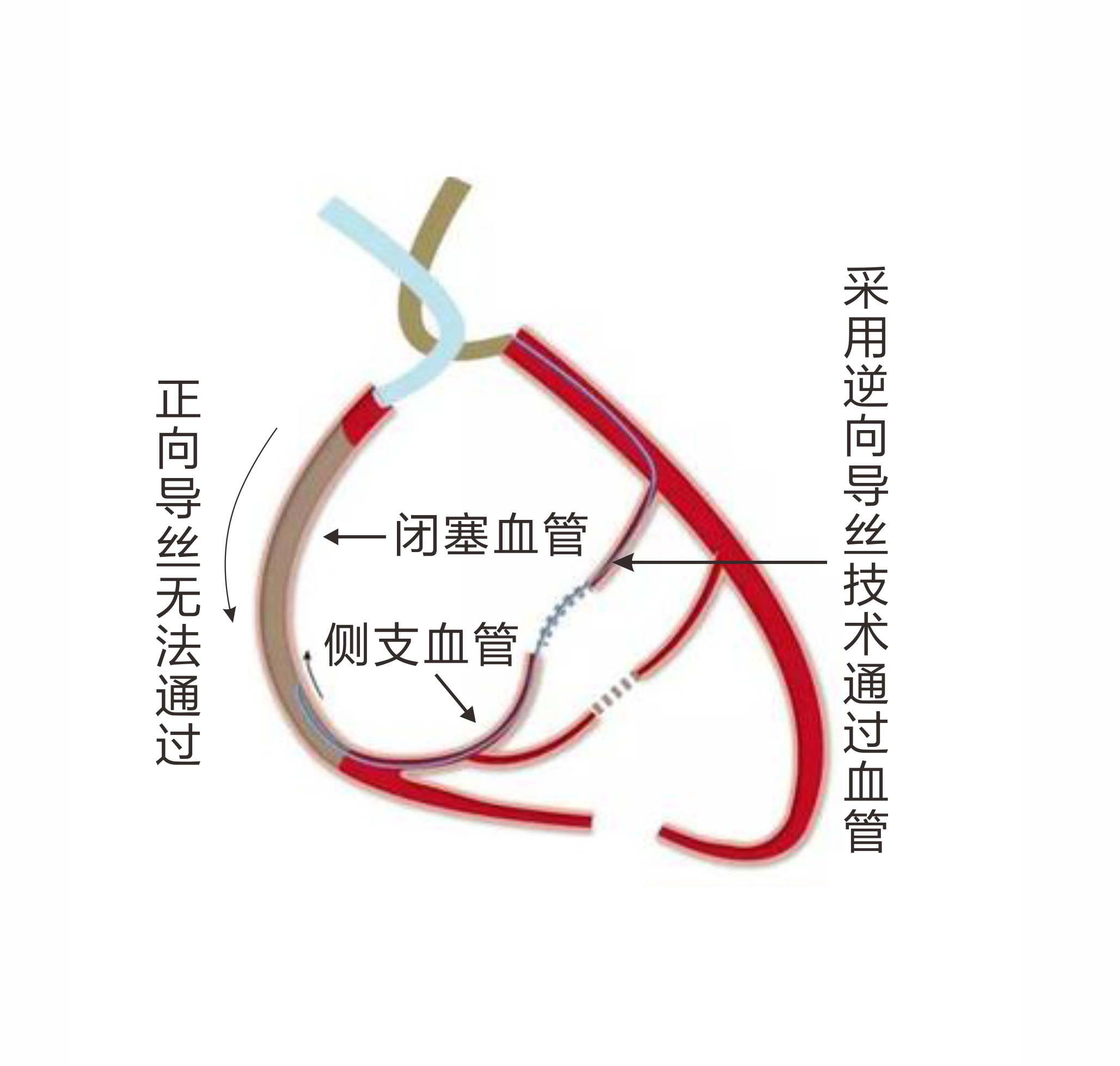 亞心醫院成功應用逆向導絲技術治療冠脈CTO病變(圖1)