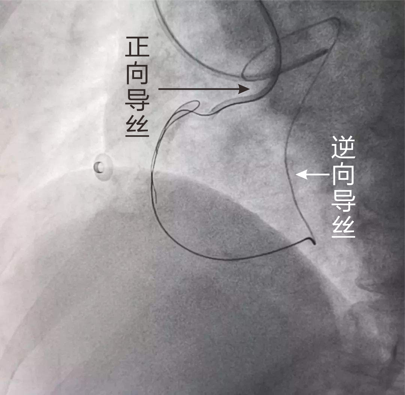 亞心醫院成功應用逆向導絲技術治療冠脈CTO病變(圖2)